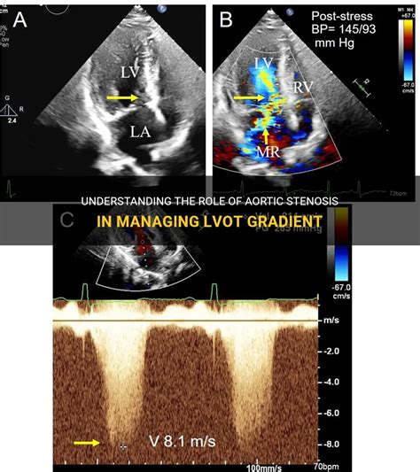 lvot toe gradient